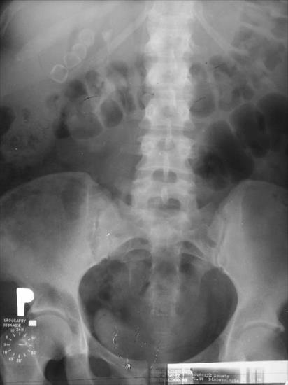 Radiologia - kamica pęcherzyka żółciowego.jpg